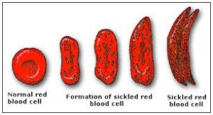perubahan morfologi sickle cell anemia