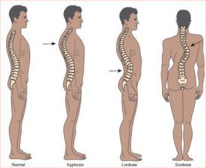 spine-disorders